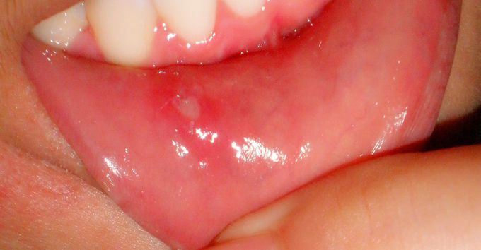 Aphthous Ulceration