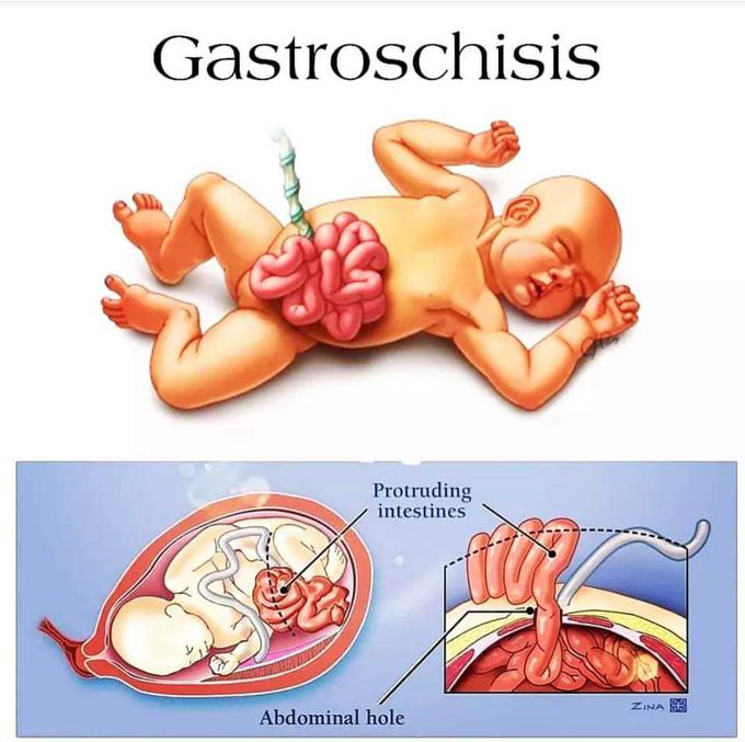 GASTROSCHISIS