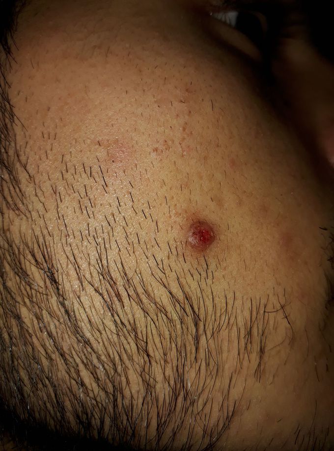 Rash on face