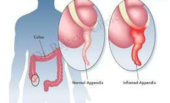 Acute appendicitis