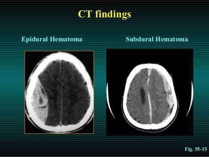 #Hematoma