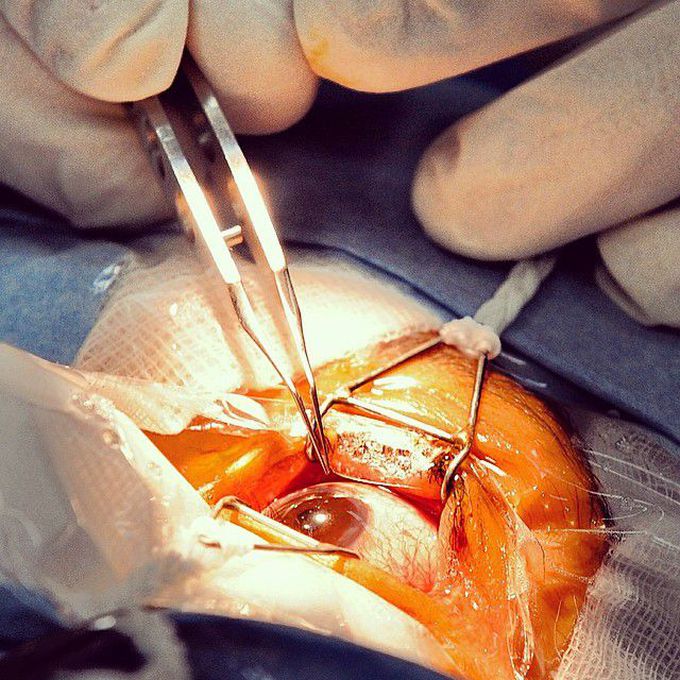 Cataract surgery - removing of the clouded lens, which affects vision