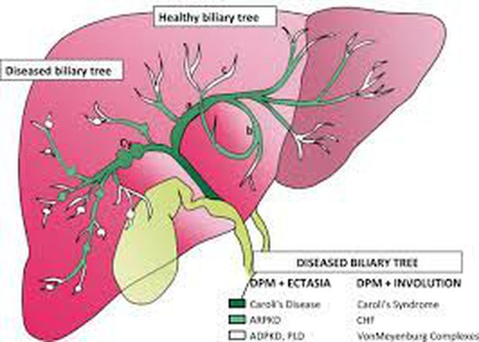 Treatment for carolis disease