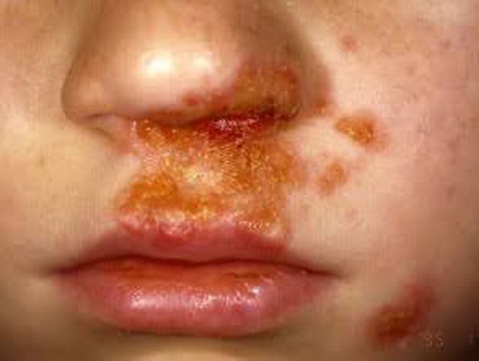 Impetigo