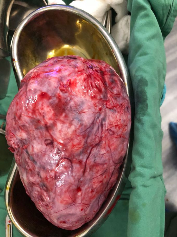 Large fibroid. (Similar to 24 week gravid uterus)