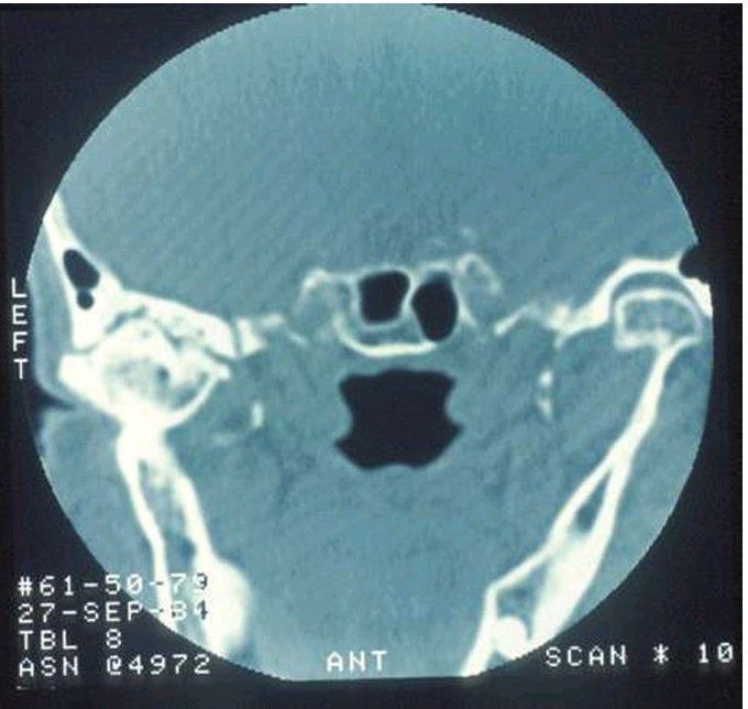 Bony ankylosis.