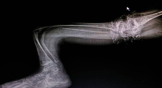 Osteogenesis imperfecta or Type l collagen,the most common inherited disease and cause by diffeciencies of synthesis of tupe l collagen