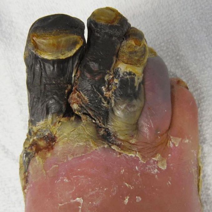 Dry gangrene affecting the toes