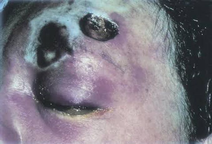 Mucormycosis