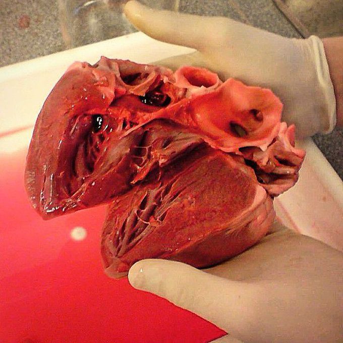 Hypertrophic cardiomyopathy