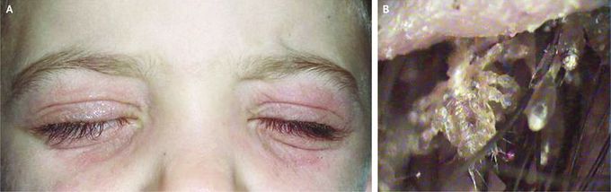 Phthiriasis Palpebrarum in a Child