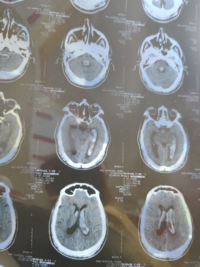 Hemorrhagic CVA extending in both ventricles