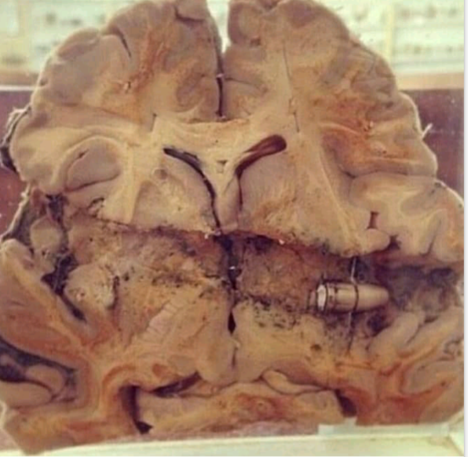 How a gunshot in the head looks like