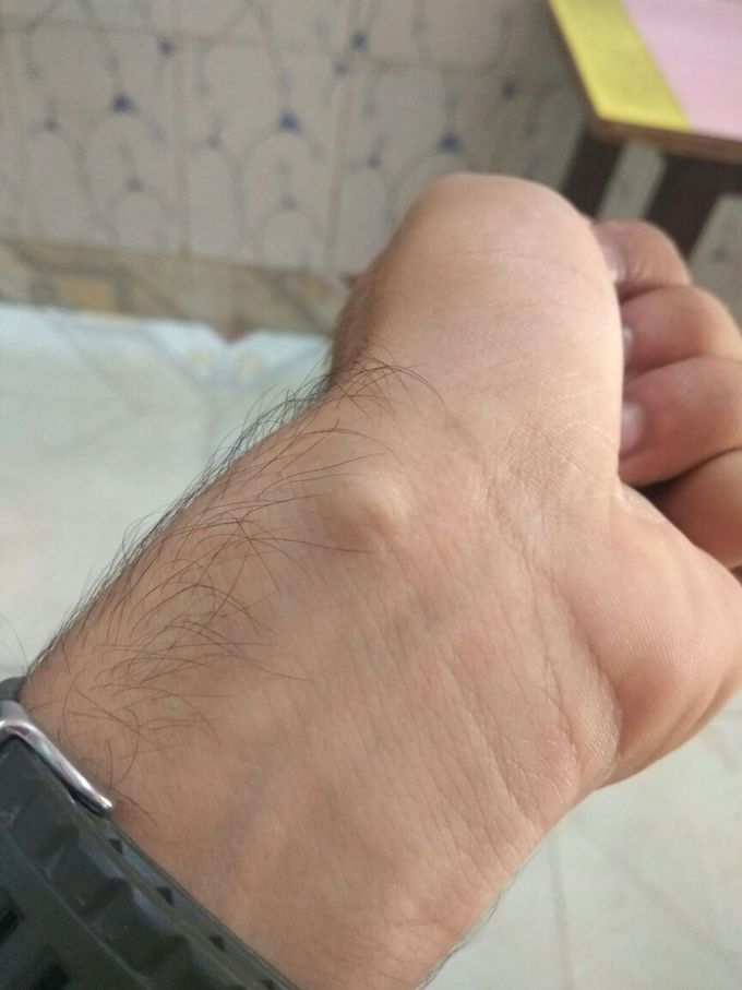 Synovial cyst or not