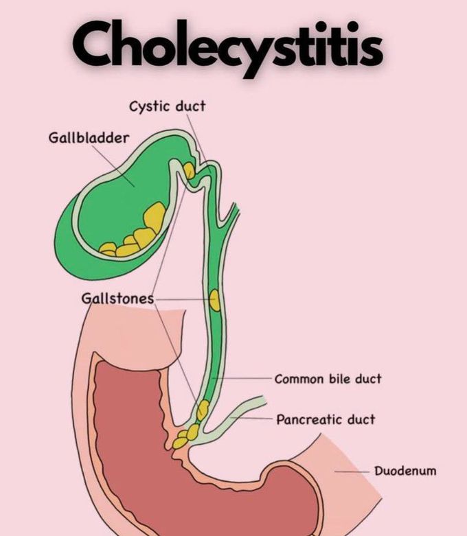 Cholecystitis