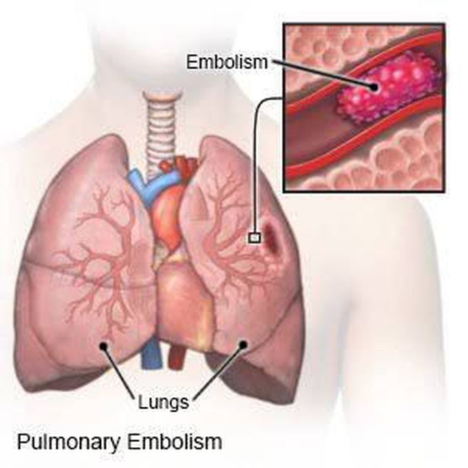 Treatment of pulmonary embolism