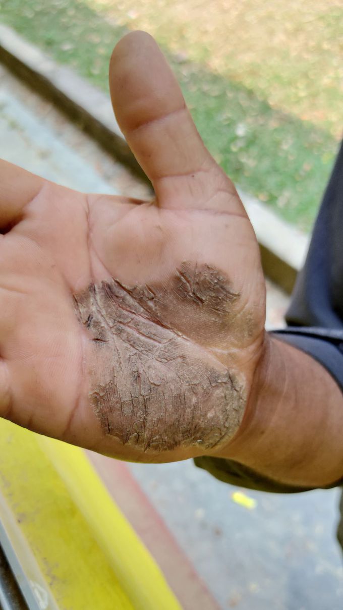 Palmar psoriasis.