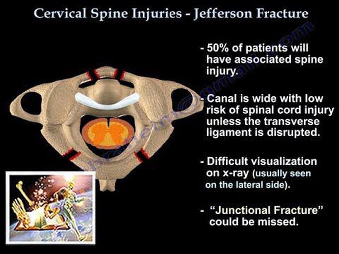 Jefferson Fracture: Overview