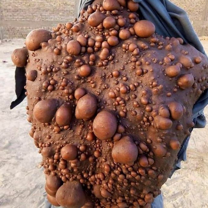 NEUROFIBROMATOSIS