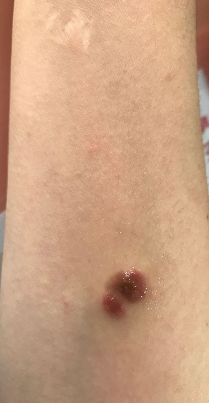 Diagnosis for this. ✌🏻