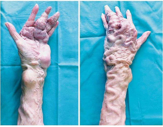 Parkes Weber syndrome