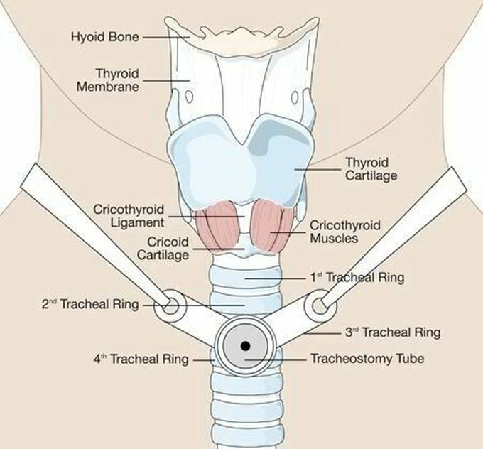 Trachea With tracheostomy tube