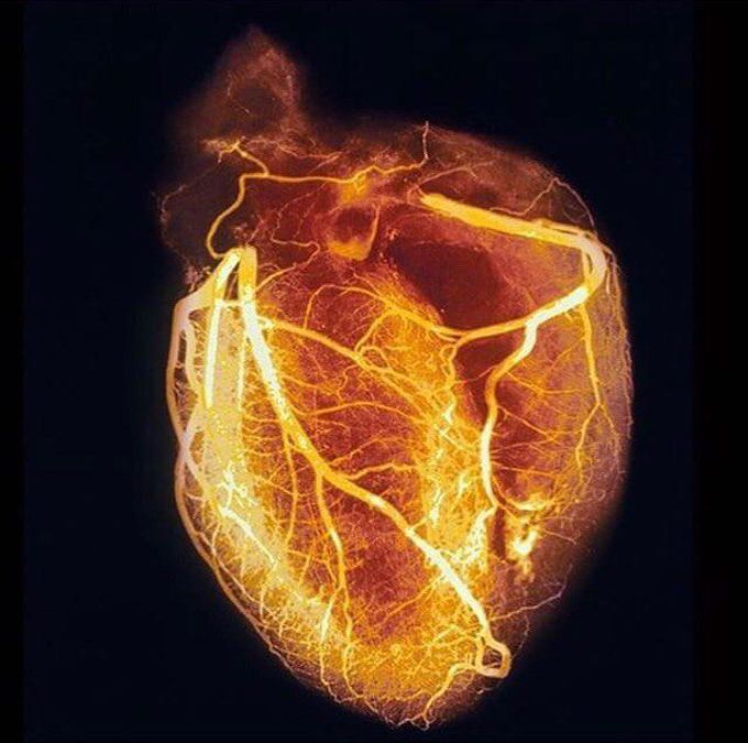 Angiogram of the heart