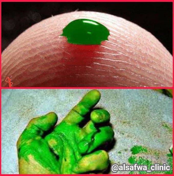 Sulfhemoglobinemia