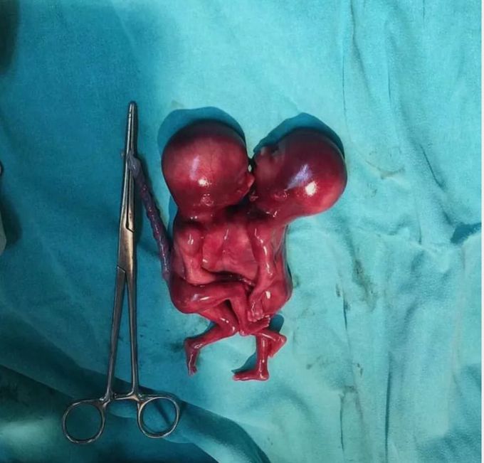 Fetus