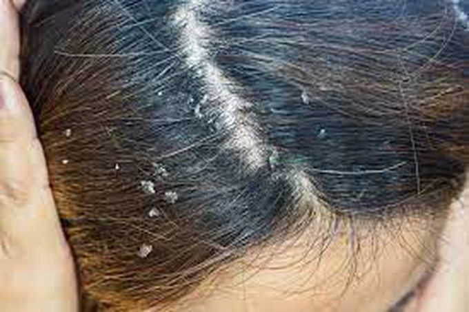 Causes of dandruff