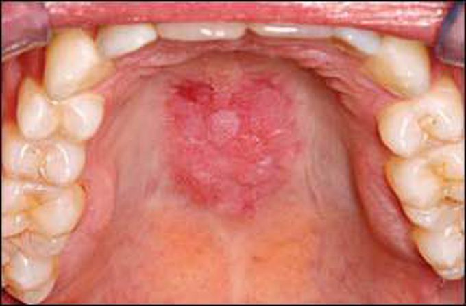 Discrete red and white plaque on the hard palate in a patient with discoid lupus erythematosus.
