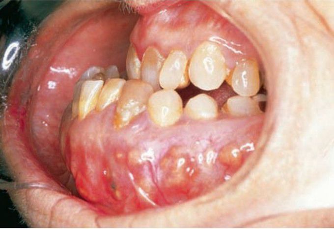 Paget's disease of mandible
