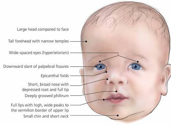 These are the symptoms of Rasopathy syndrome