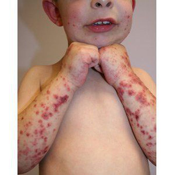 Henoch-schonlein purpura