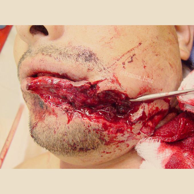 Maxillofacial laceration caused by a gunshot wound