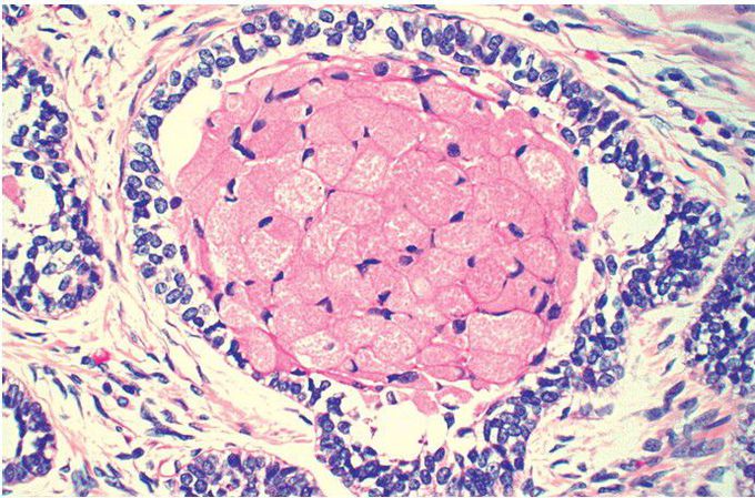 Ameloblastoma (Granular Cell Variant). 