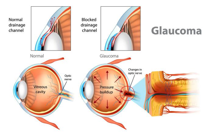Clinical Features of glaucoma