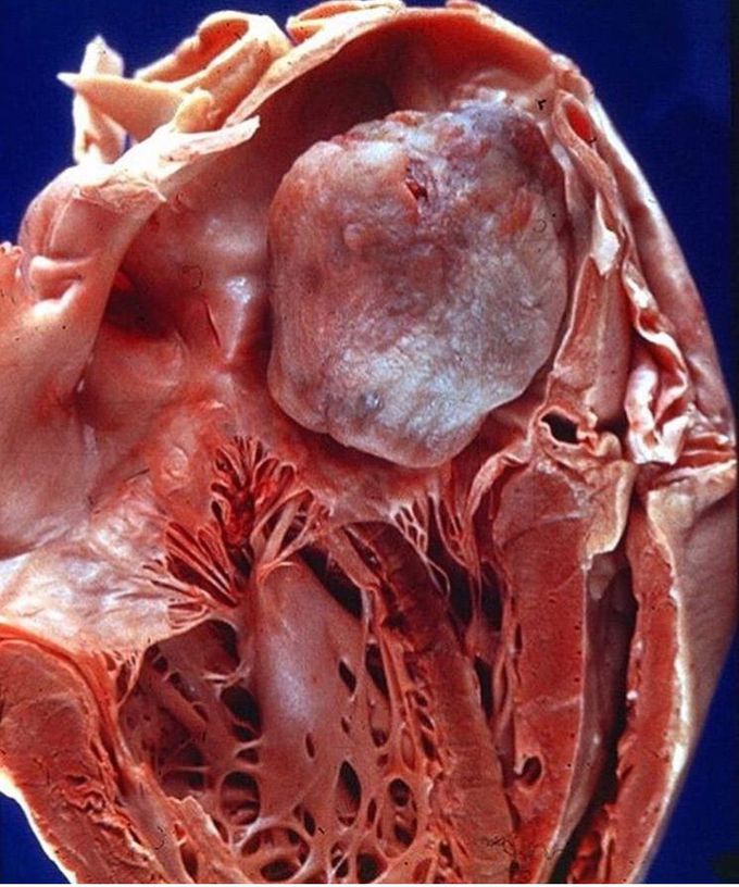 Atrial  myxoma