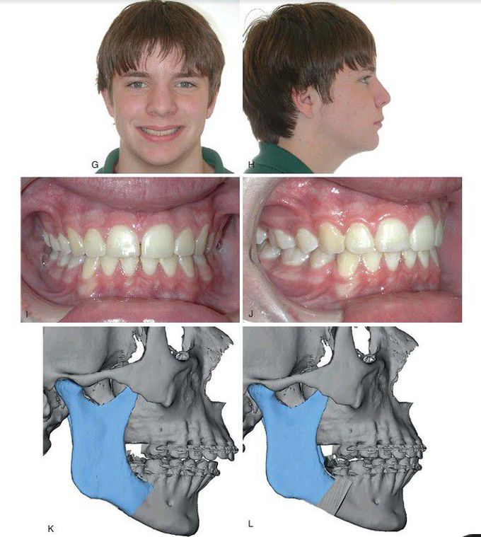 Mandibular advancement