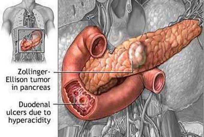 Zollinger-Ellison syndrome