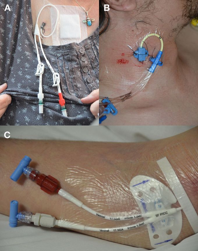 Indications of Central Venous Line Placement