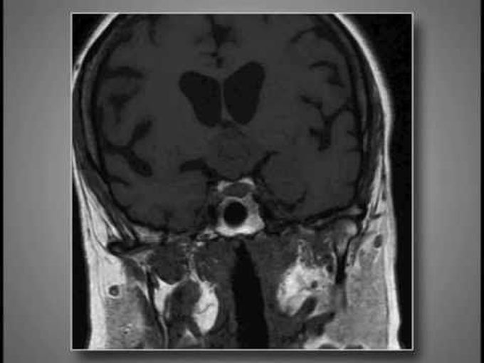 Transcortical--transforaminal microscopic approach for purely intraventricular craniopharyngioma