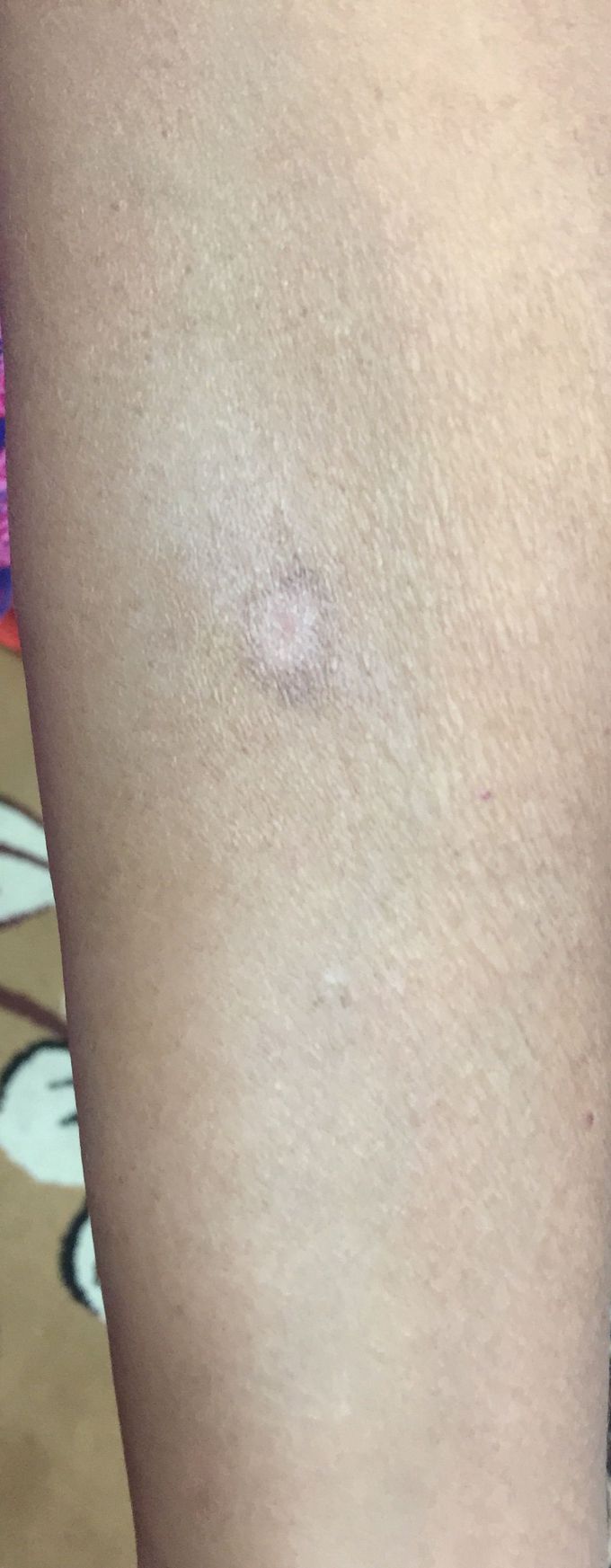 female pt of age 45yr presented with this on hand