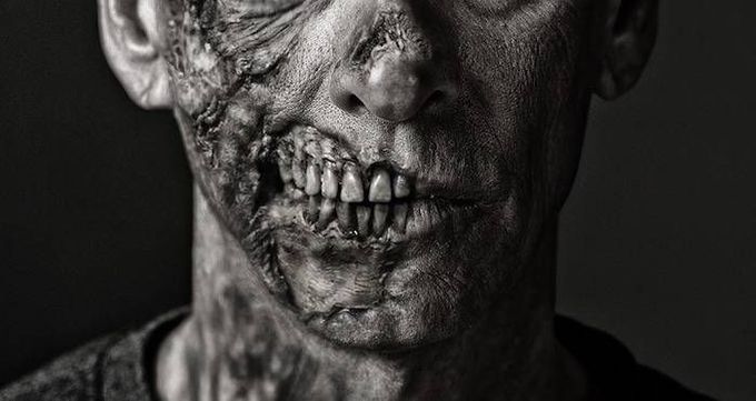 Cotard's syndrome