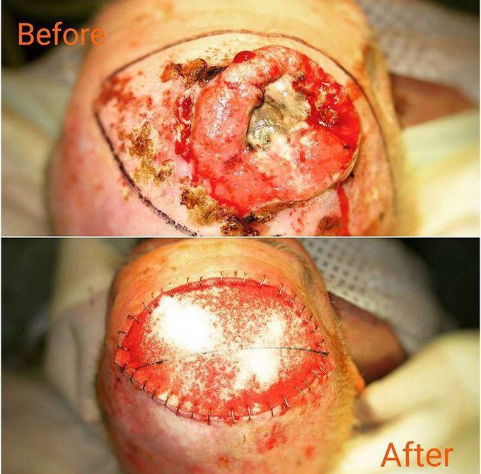 Cancer of the scalp! 🤕