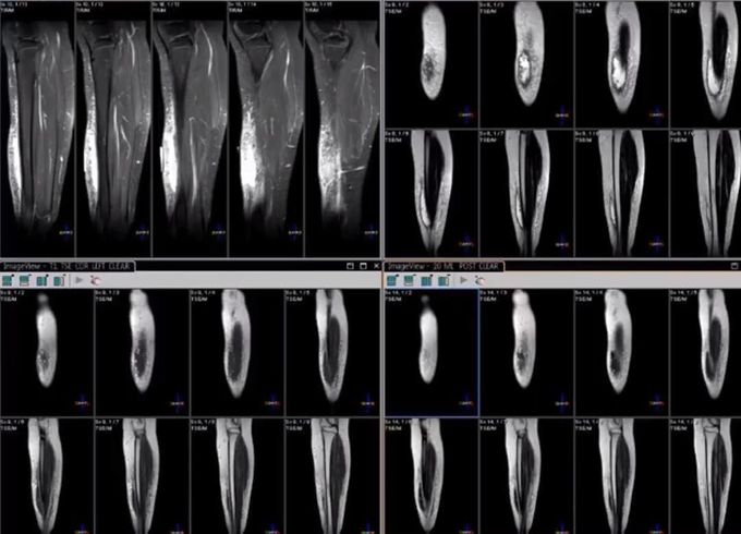 Lower leg abscess