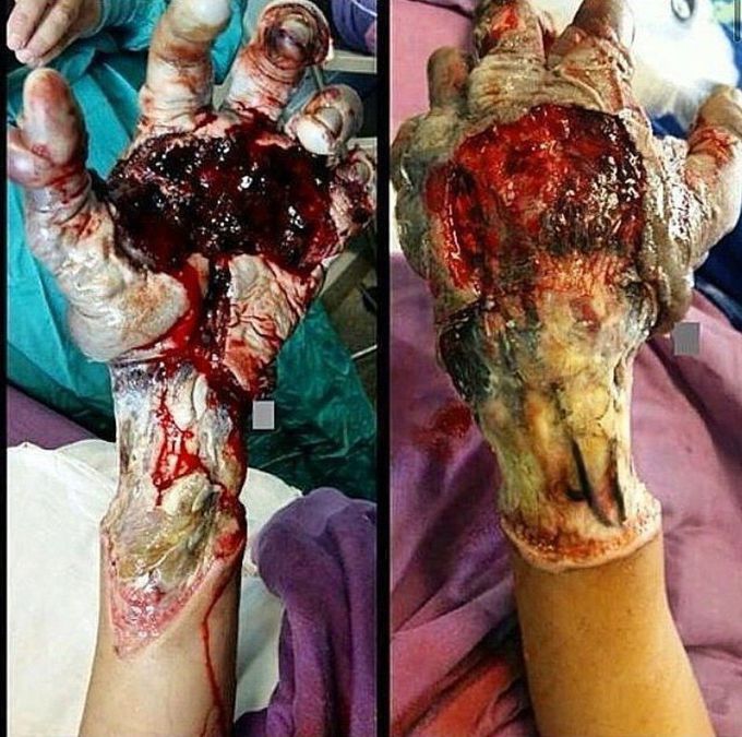 High voltage burn