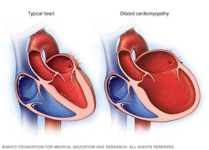 causes of dilated cardiomyopathy