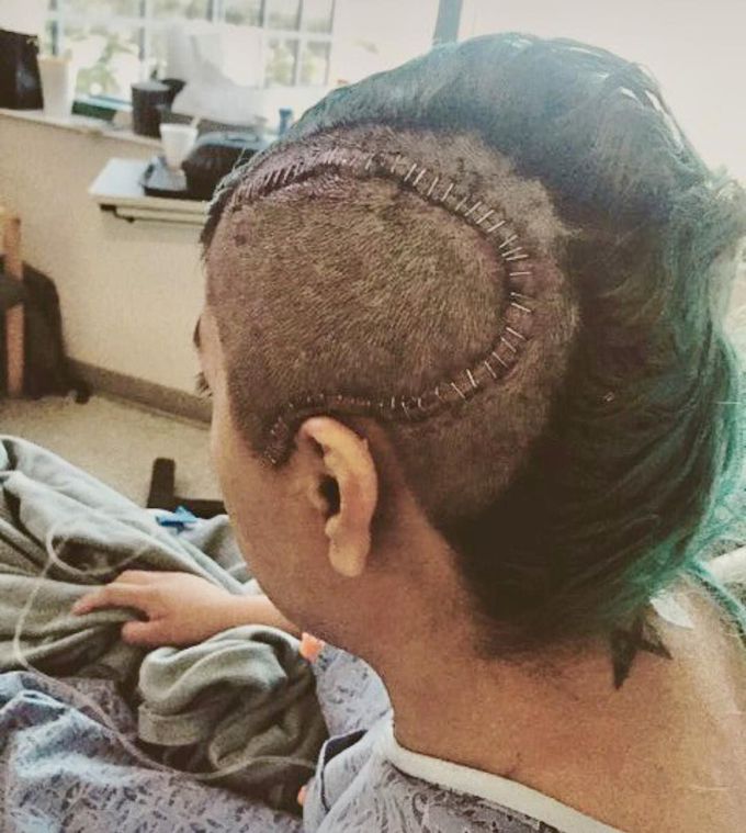 Patient after Brain Arteriovenous malformation surgery