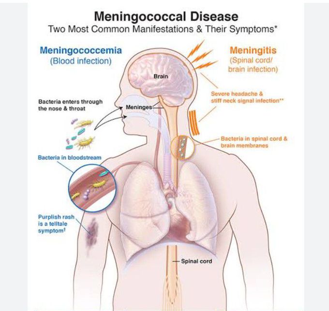 Meningococcal Disease